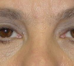Blepharoplasty Before & After Patient #2529