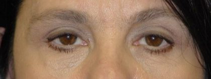 Blepharoplasty Before & After Patient #2529
