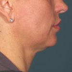 Ultherapy Before & After Patient #2713