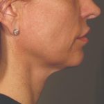 Ultherapy Before & After Patient #2713