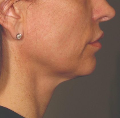 Ultherapy Before & After Patient #2713