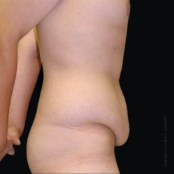 Tummy Tuck Before & After Patient #2505