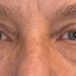 Blepharoplasty Before & After Patient #2530