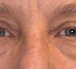 Blepharoplasty Before & After Patient #2530