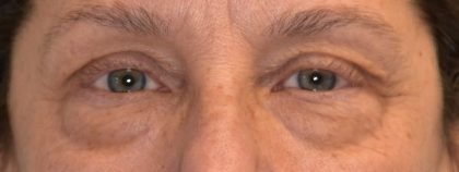 Blepharoplasty Before & After Patient #2530