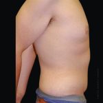 Tummy Tuck Before & After Patient #2505