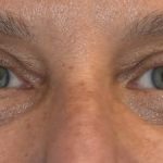 Blepharoplasty Before & After Patient #2530