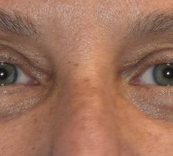 Blepharoplasty Before & After Patient #2530