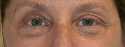 Blepharoplasty Before & After Patient #2530