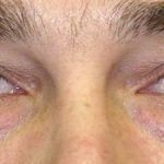 Blepharoplasty Before & After Patient #2531
