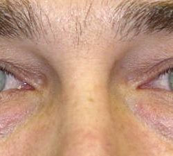 Blepharoplasty Before & After Patient #2531