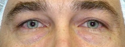 Blepharoplasty Before & After Patient #2531
