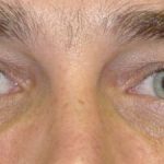 Blepharoplasty Before & After Patient #2531