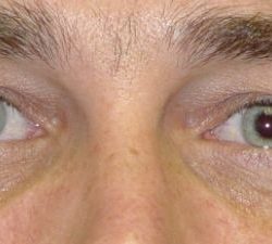 Blepharoplasty Before & After Patient #2531