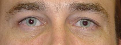 Blepharoplasty Before & After Patient #2531
