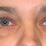 Blepharoplasty Before & After Patient #2532