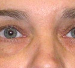 Blepharoplasty Before & After Patient #2532