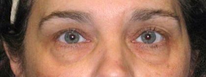 Blepharoplasty Before & After Patient #2532