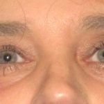 Blepharoplasty Before & After Patient #2532