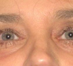 Blepharoplasty Before & After Patient #2532