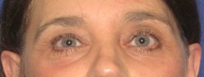 Blepharoplasty Before & After Patient #2532