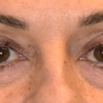 Blepharoplasty Before & After Patient #2533