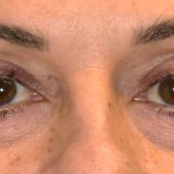 Blepharoplasty Before & After Patient #2533