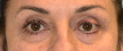 Blepharoplasty Before & After Patient #2533