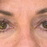 Blepharoplasty Before & After Patient #2533
