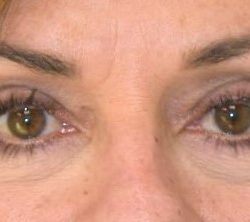 Blepharoplasty Before & After Patient #2533