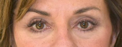 Blepharoplasty Before & After Patient #2533