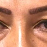 Blepharoplasty Before & After Patient #2534