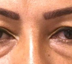 Blepharoplasty Before & After Patient #2534