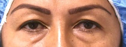 Blepharoplasty Before & After Patient #2534