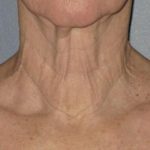 Ultherapy Before & After Patient #2706