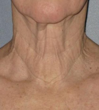 Ultherapy Before & After Patient #2706