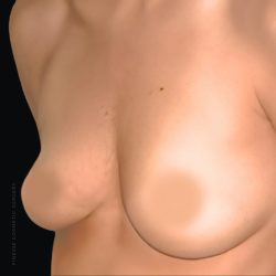 Breast Augmentation Before & After Patient #2607