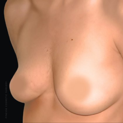 Breast Augmentation Before & After Patient #2607