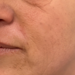 Botox Before & After Patient #2578