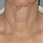 Ultherapy Before & After Patient #2706