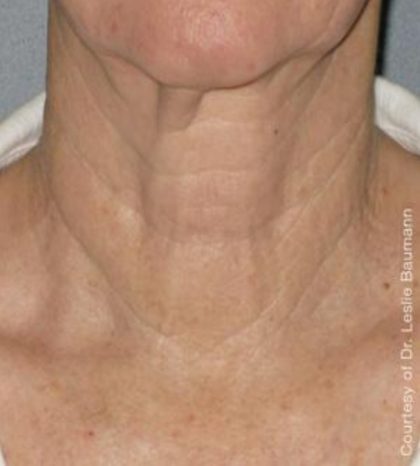 Ultherapy Before & After Patient #2706