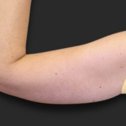 Brachioplasty (Arm Lift) Before & After Patient #2516