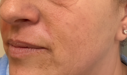 Botox Before & After Patient #2578