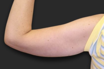 Brachioplasty (Arm Lift) Before & After Patient #2516