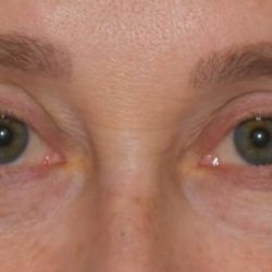 Blepharoplasty Before & After Patient #2525