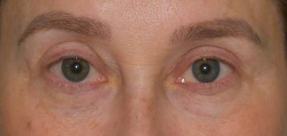 Blepharoplasty Before & After Patient #2525