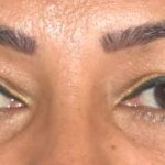 Blepharoplasty Before & After Patient #2534