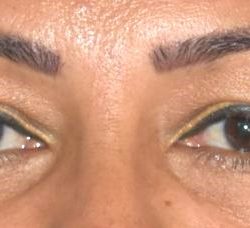 Blepharoplasty Before & After Patient #2534