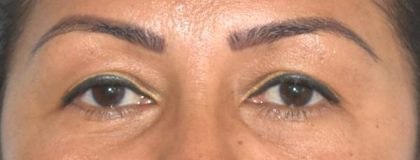 Blepharoplasty Before & After Patient #2534