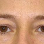 Blepharoplasty Before & After Patient #2535